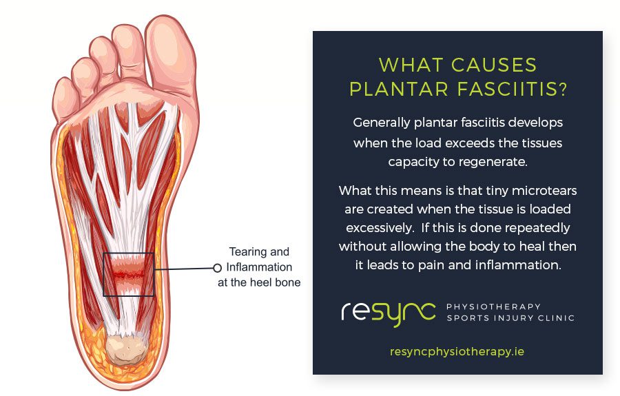 What Causes Plantar Fasciitis - ReSync Physio - Dublin