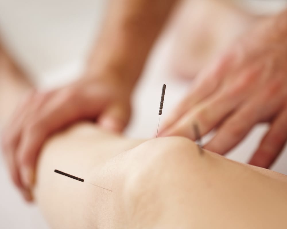 Dry Needling Services