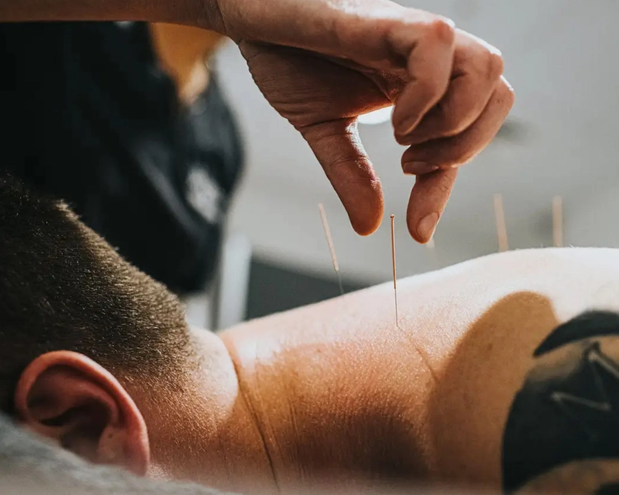 Acupuncture Services