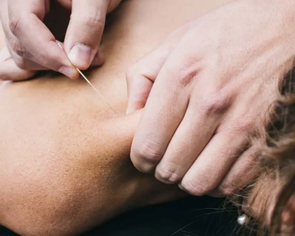 Dry Needling Dublin