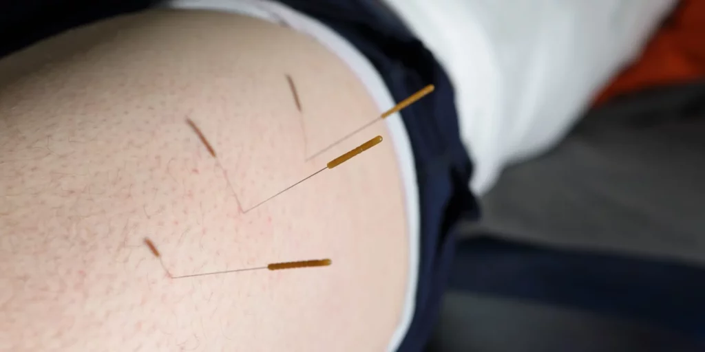 Acupuncture Dublin